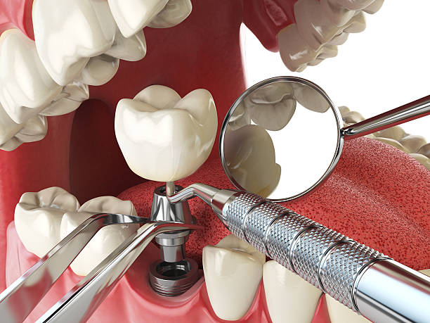 Best Broken or Cracked Tooth Emergency Dentist in Hialeah, FL